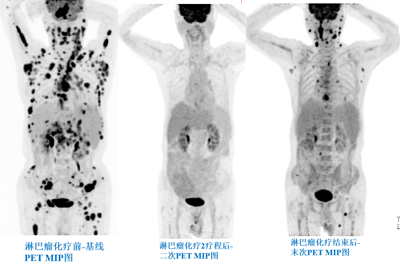 淋巴瘤化疗前、中、后PETCT疗效评价.png