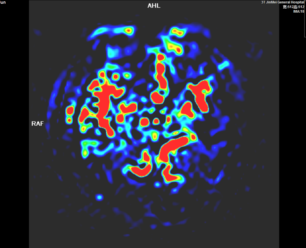 头颅灌注成像ASL.PNG