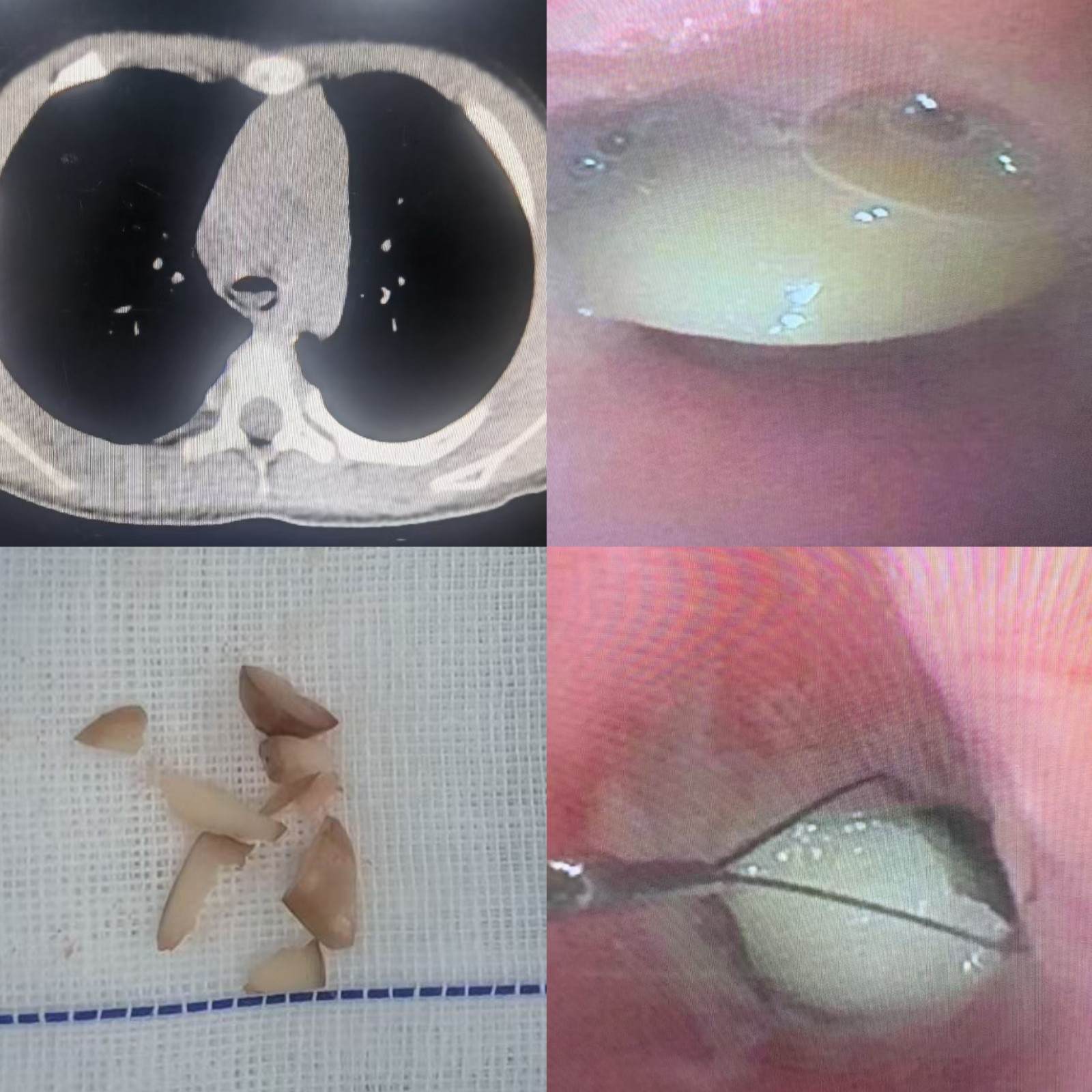 气管内异物-花生.jpg